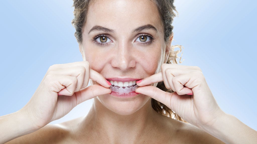 As patents for Invisalign expire, expect more options at lower prices. Photograph by Vasileios Economou/Getty Images.