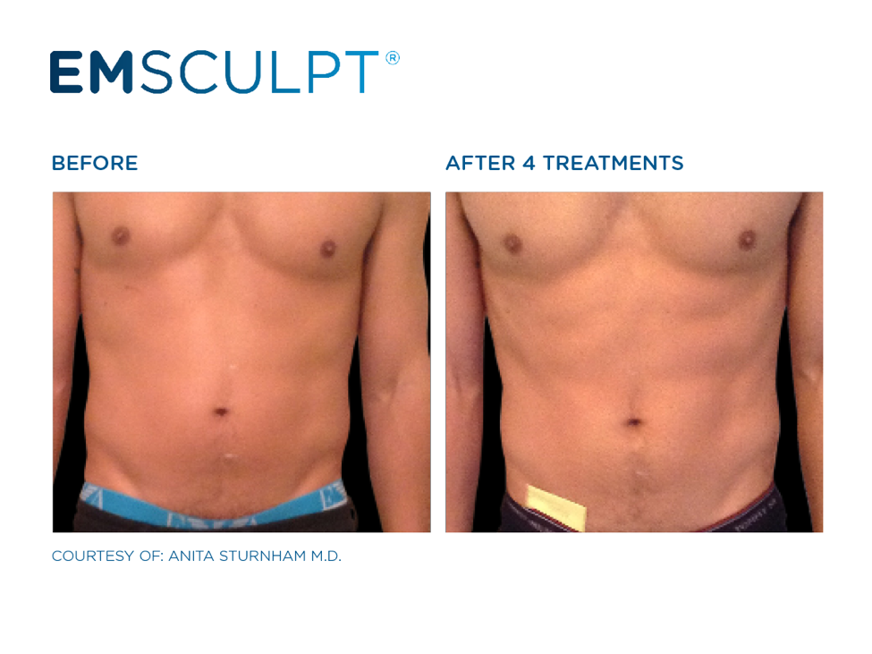 Emsculpt DC