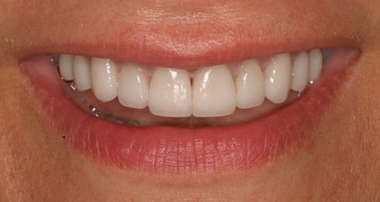 veneers afte - Washingtonian