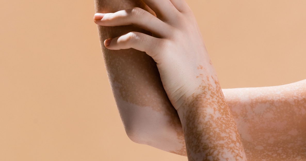 How I'm Helping My Daughter Navigate Her Vitiligo - Vimarsana News